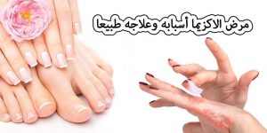 مرض الاكزيما أسبابه وعلاجه طبيعياً
